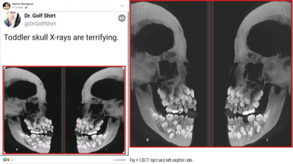 hyperdontia skull